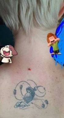 implant microdermal