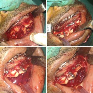 Mandibular fracture