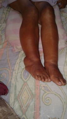 Edema de miembros inferiores. 