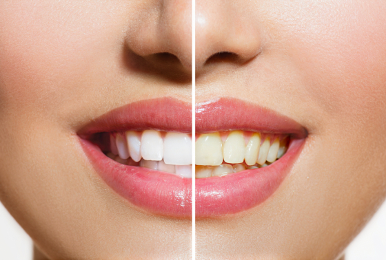 Clareamento Dental: Passo a Passo
O clareamento dental é feito com auxílio de um gel clareador, existindo três tipos de clareamento: o assistido, o de consultório e o associado.

Saiba mais: http://cruzodontologia.com.br/clareamento-dental/