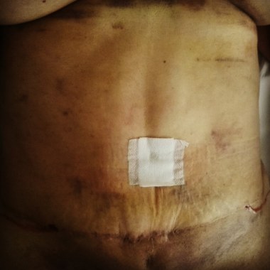 Postoperatorio estético