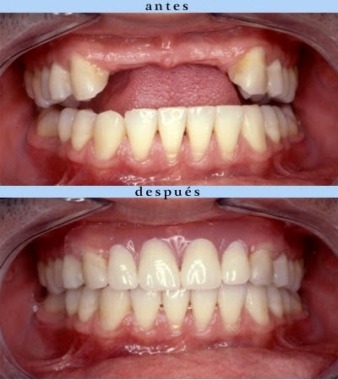 Prótesis fija o removible, para reemplazar piezas dentales ausentes