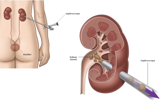 PCNL