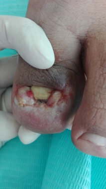 Onicocriptosis grado 3. 