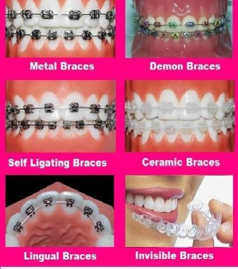 different types of braces at Aspen Dental Care to correct misaligned teeth.