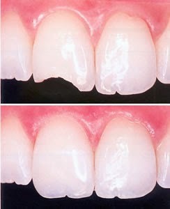Resinas, restaurar dientes fracturafos o caries