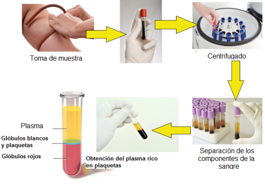 Tratamiento para recuperacion articular
                          PRP