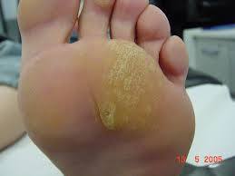 Hiperqueratosis