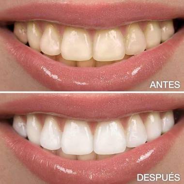 TEETH WITHENING