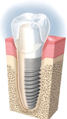 IMPLANT DENTAL