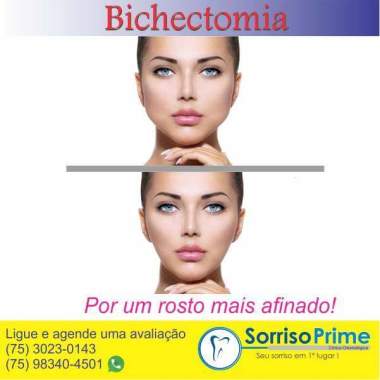 Bichectomia. Por um rosto mais bonito. 