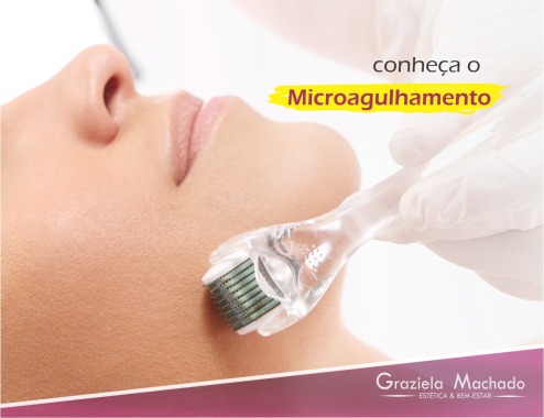 Conheça os benefícios do microagulhamento, o melhor tratamento para cicatrizes de acne. Também indicado para poros dilatados, rugas médias e calvície.