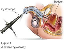CISTOSCOPIA FLEXIBLE