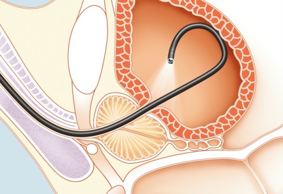 CISTOSCOPIA FLEXIBLE