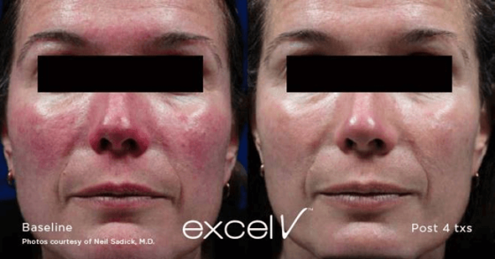 EXCEL V™ LASER FOR VASCULAR AND PIGMENTED LESIONS