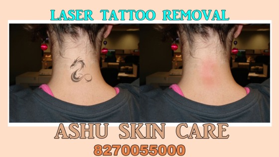 Laser Tattoo removal 