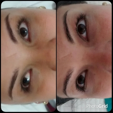 Tratamento para olheira e áreas escurecidas em volta dos olhos.