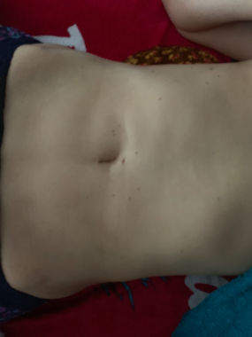 Started massage 4 weeks late on 1st week the fibrosis  minimises 