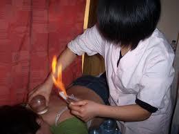 Cupping