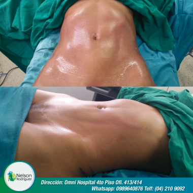 Lipoescultura Vaser