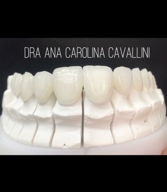 Lente de contato dental