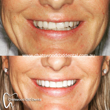 Chatswood_CBD_veneer.jpg