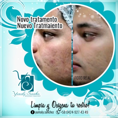 Brasil | Nuevo tratamiento Dermatologico