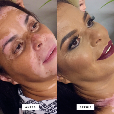 vitiligo2.png