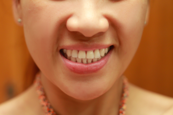 Tratamento da doença periodental
Periodontia é a especialidade odontológica que trata não só da gengiva, mas de todo complexo de sustentação do dente, composto pela gengiva, osso alveolar e ligamento periodontal.  http://cruzodontologia.com.br/periodontia/