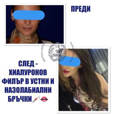 Преди/След ➡️ Хиалуронов филър в устни и назолабиални бръчки