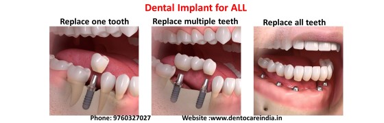Dental Implant